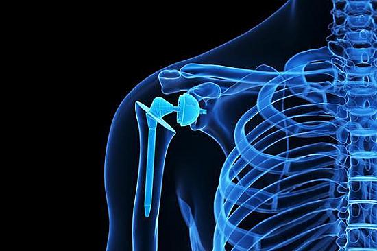 Intensive Musculoskeletal Parameter Tracking